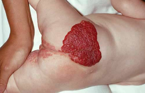 Nevus flammeus - Right Diagnosis